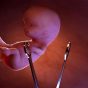 سقط‌جنین، احتمال نازایی مادر تا آخر عمر را افزایش می‌دهد